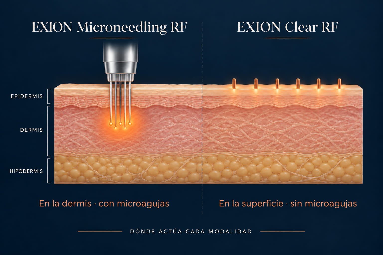 Corte de la piel comparando las dos modalidades: EXION Microneedling RF entrega la energía en la dermis mediante microagujas; EXION Clear RF actúa sobre las capas superficiales de la piel, sin microagujas.